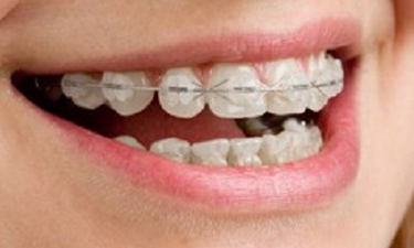 Clear (ceramic) braces