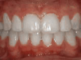 Crowding of the teeth, after treatment