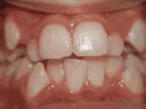 Crowding of the teeth, before treatment