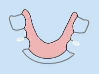 Orthodontic appliance illustration