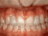 Missing lateral incisors, after treatment