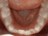 Crowding of lower permanent teeth, before non-braces treatment