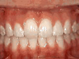 Protruding front teeth, after treatment