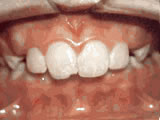 Protruding front teeth, before treatment