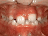 Before Phase-One treatment