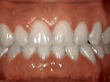 Spacing of the teeth, after treatment
