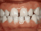Spacing of the teeth, before treatment