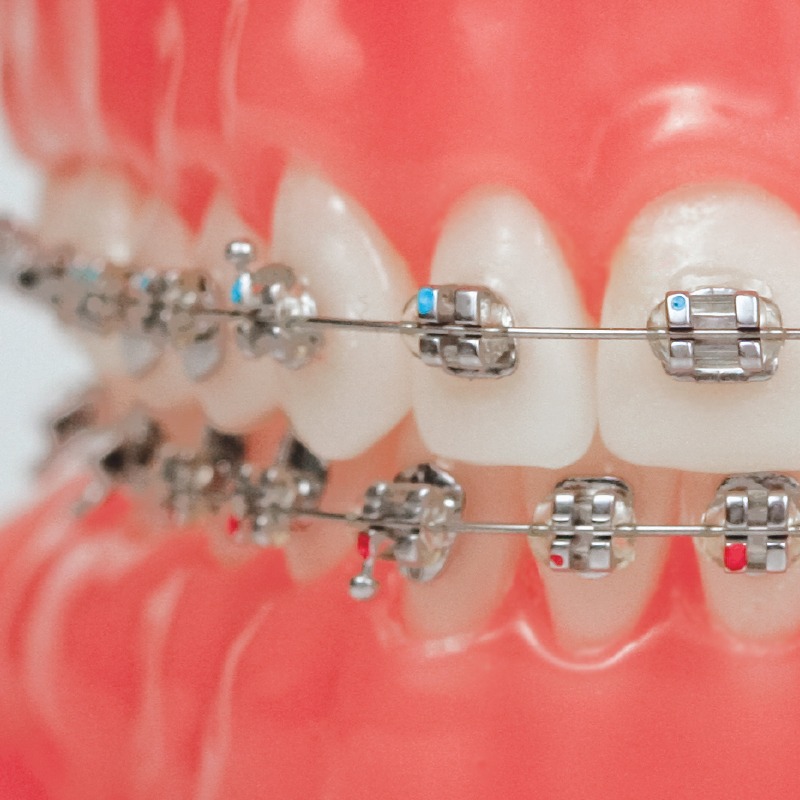Traditional braces
